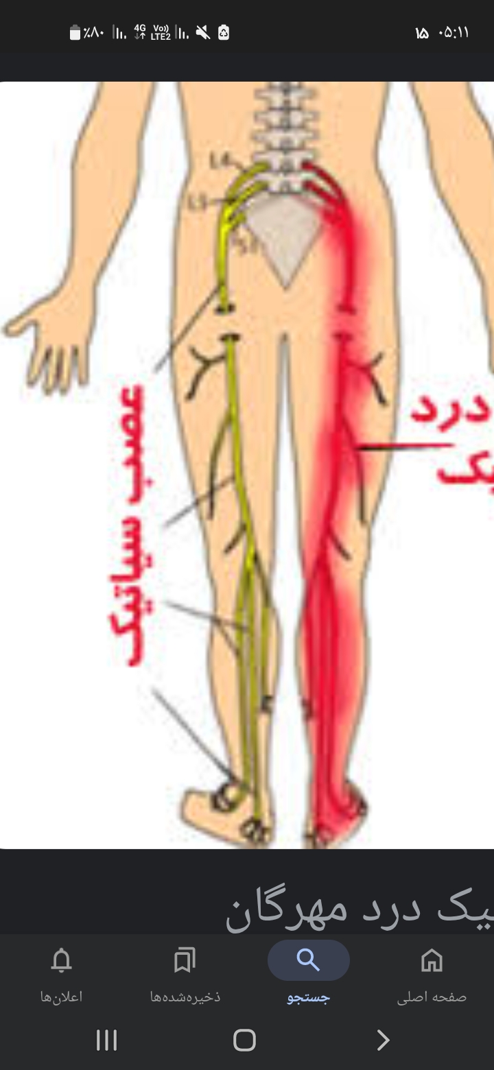 درمان کامل ضمانتی سیاتیک